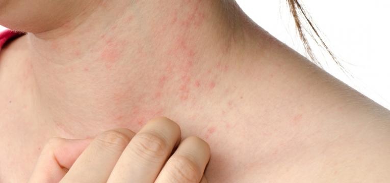 alergia ao sol mulher com pele com alergia