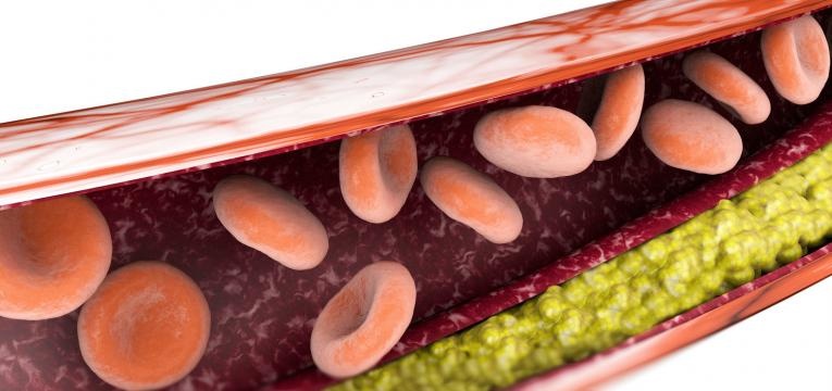 aneurisma da aorta corrente sanguinea