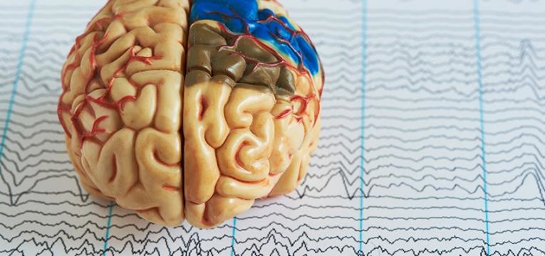 epilepsia