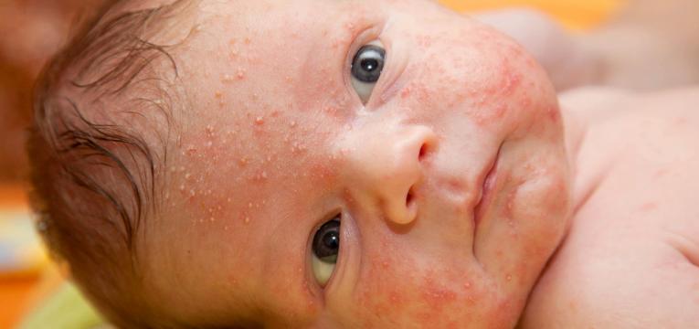 sintomas dermatite atopica