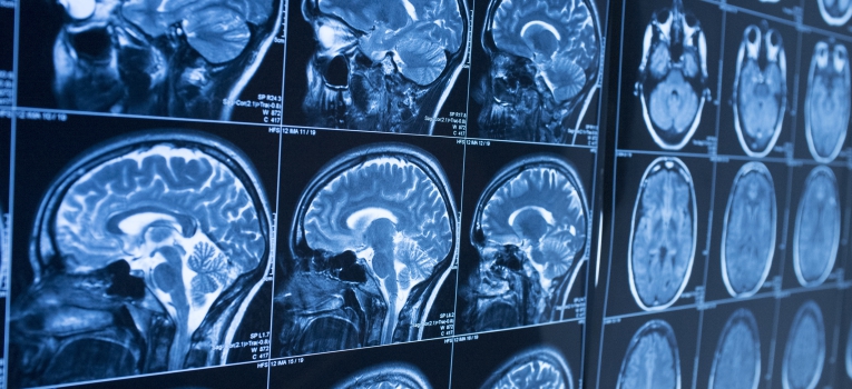 acao neuro protetora