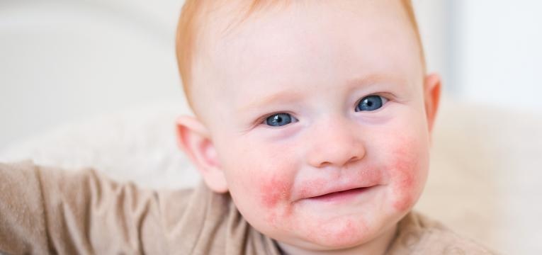 alergias alimentares mais comuns na infancia sinais no rosto